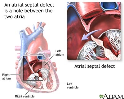 imagini defectul septal